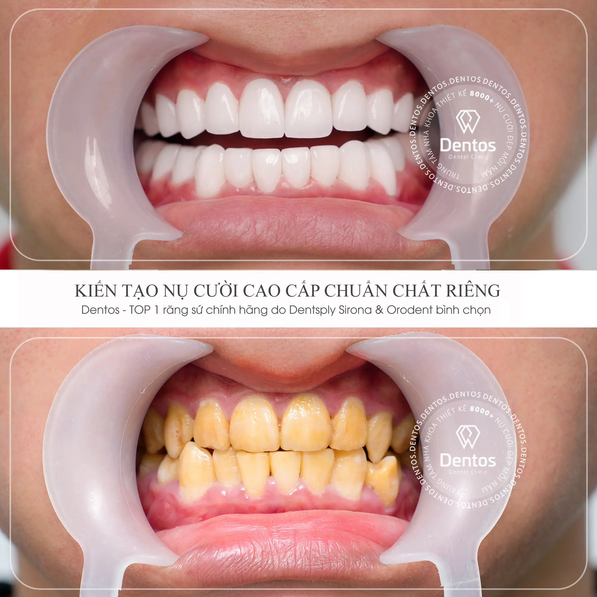 Răng ố vàng nặng nên bọc răng sứ để cải thiện thẩm mỹ